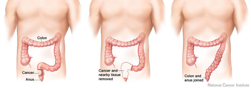 Colorectal Cancer Diagram and Symptoms